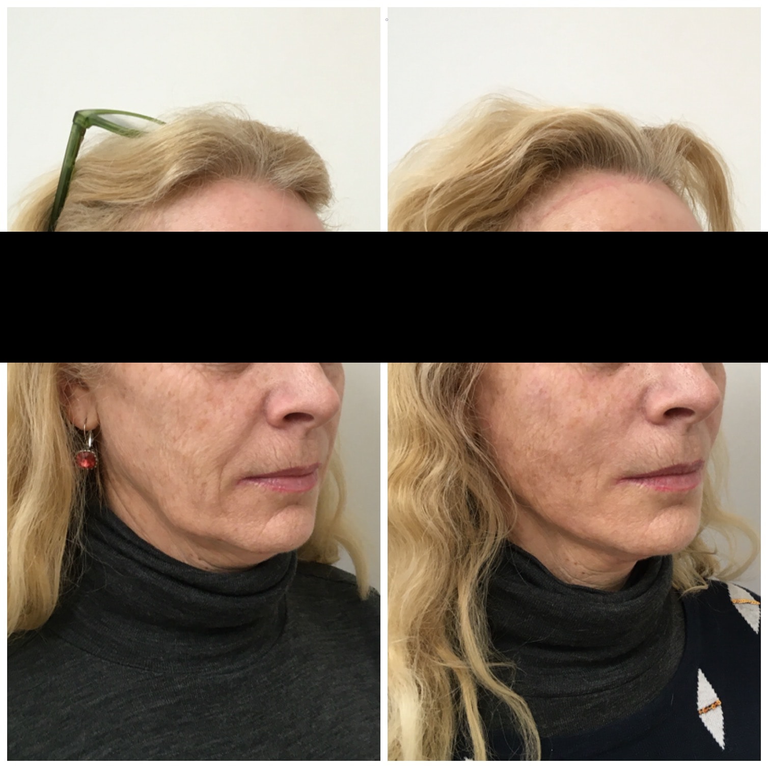 Cheek and jowl thread lift before and after