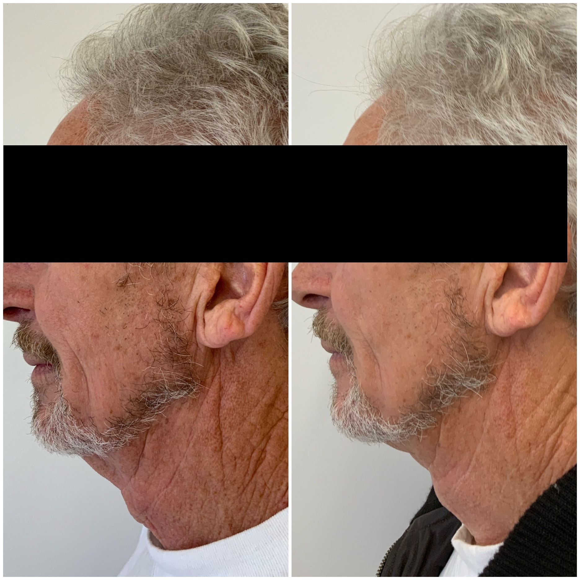 Neck thread lift before and after