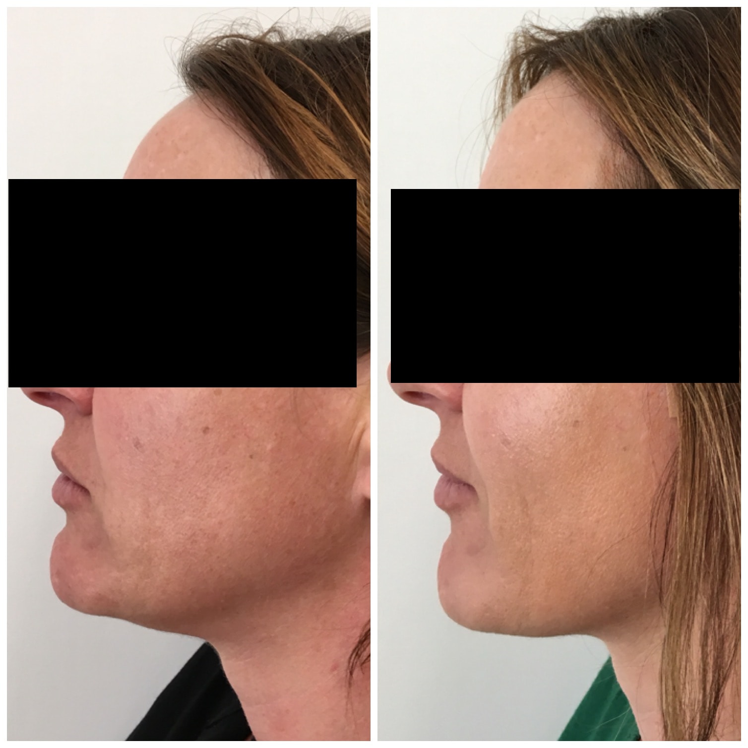 Thread lift jawline before and after