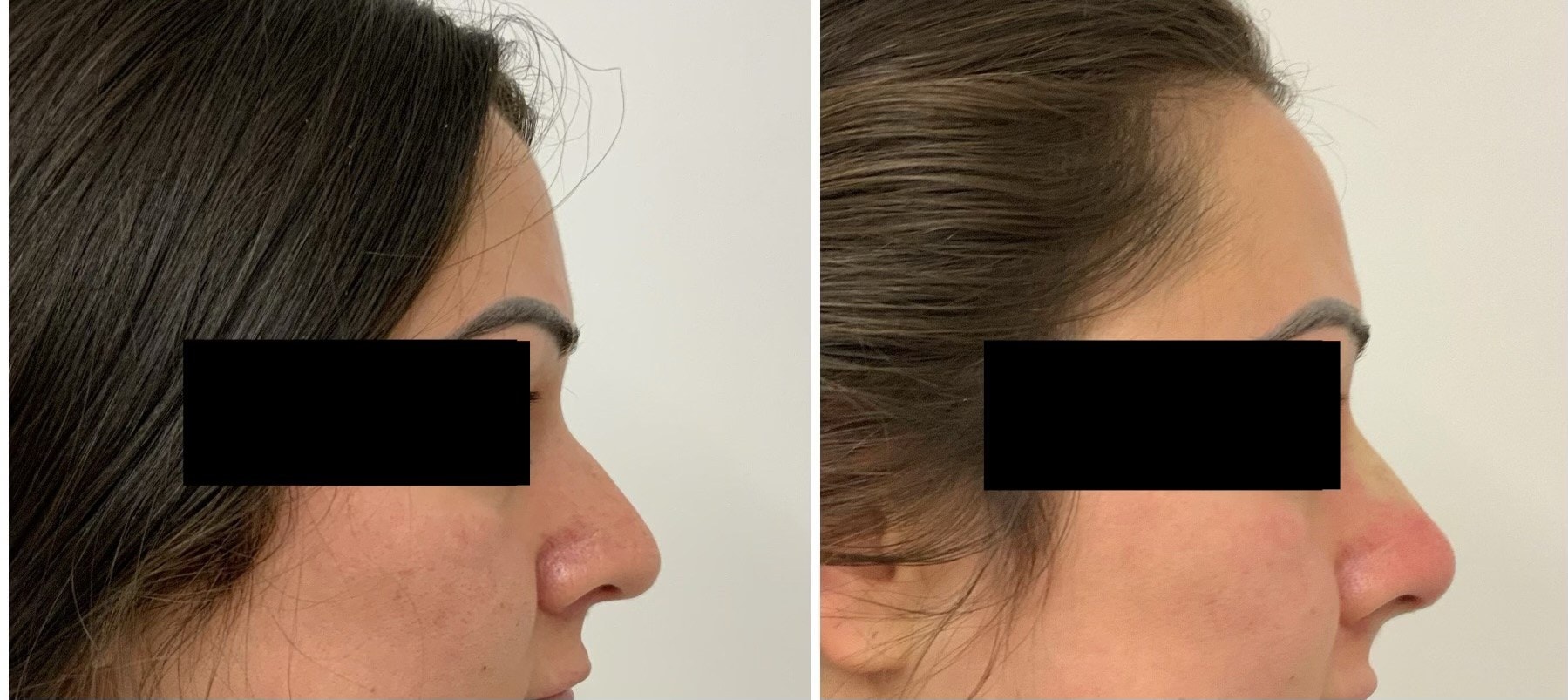 Nose Thread Lift