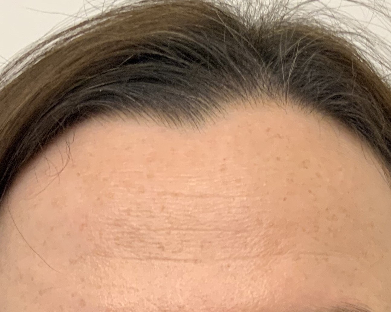 Forehead lines suited to anti-wrinkle injections