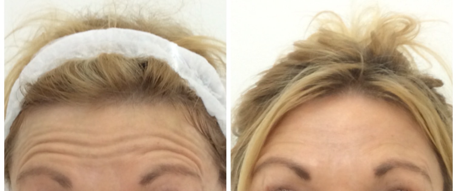 Botulinum toxin to forehead lines