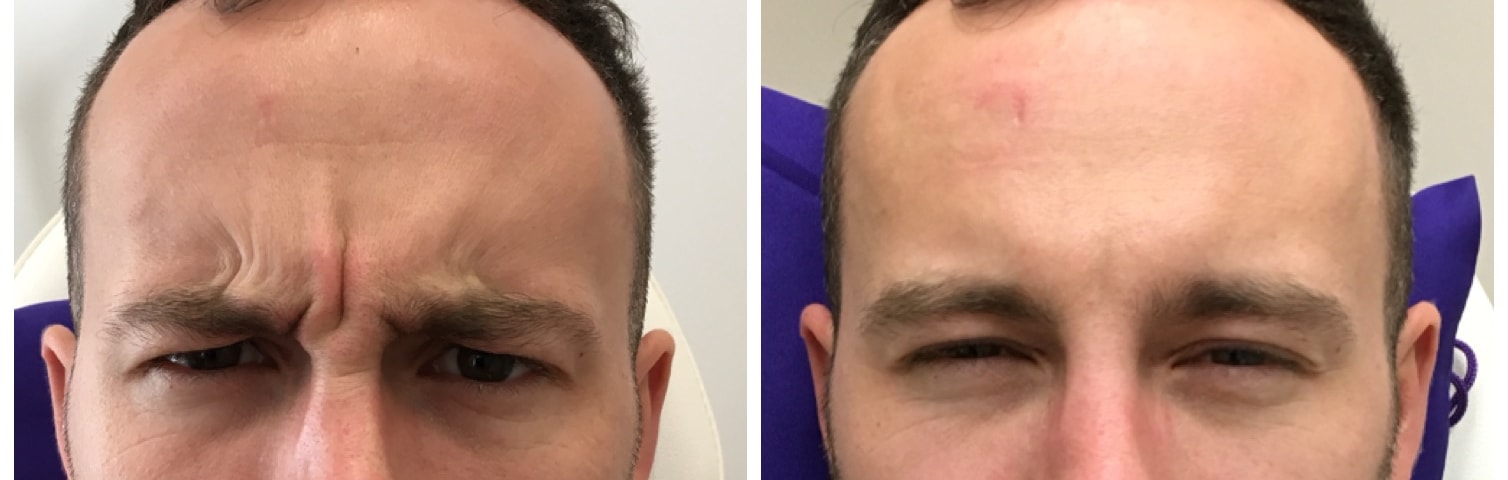 Botulinum toxin to frown lines