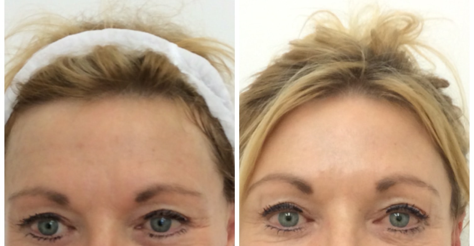 Botulinum toxin to lift brows